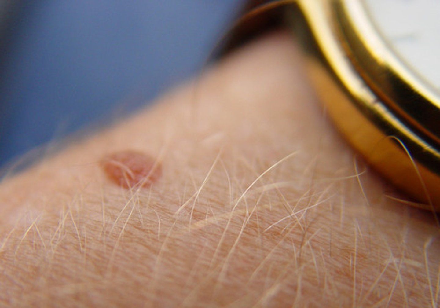 <p>pigmented nevus</p>