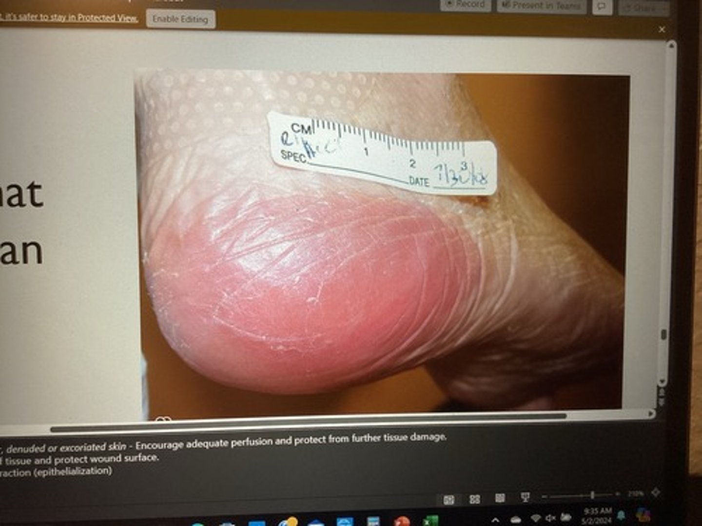 <p>stage 1</p><p>Encourage adequate perfusion &amp; protect from further tissue damage &amp; friction.</p>