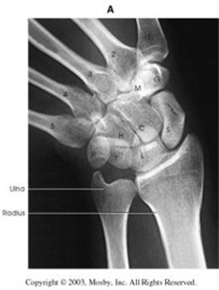 <p>Scaphoid w adjacent articulations open</p><p>-No rotation of wrist</p><p>-maximum ulnar deviation</p><p>-distal radius and ulna carpals and proximal half of metacarpals</p>