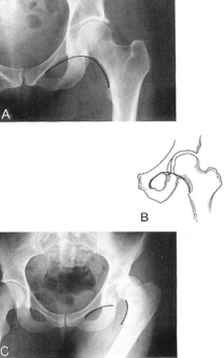 <p>Clinical significance of Shenton's line</p>