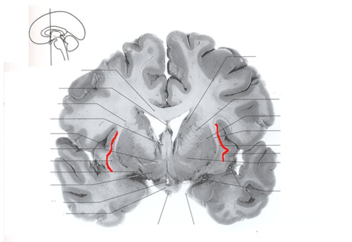 <p><strong>Bidirectional communication</strong> linking the inferior frontal gyrus (Broca’s), the middle part of the superior temporal gyrus (Wernicke’s) and inferior parietal lobule (angular gyrus),</p>