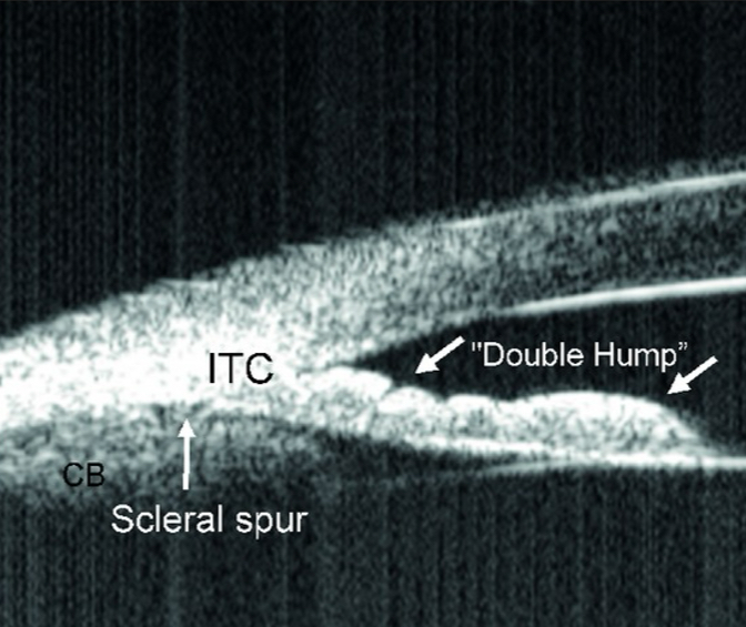 <p>Indentation Gonioscopy; UBM</p>