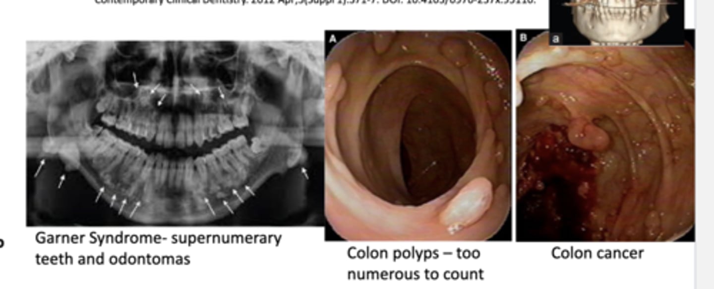 <p>-autosomal dominant</p><p>-supernumerary teeth</p><p>-osteomas</p><p>-odontomas</p><p>-many colon polyps w/ 100% chance of malignant change--&gt; variant of familial adenomatous polyposis</p><p>-colon cancer at 20-40 years old without treatment</p>