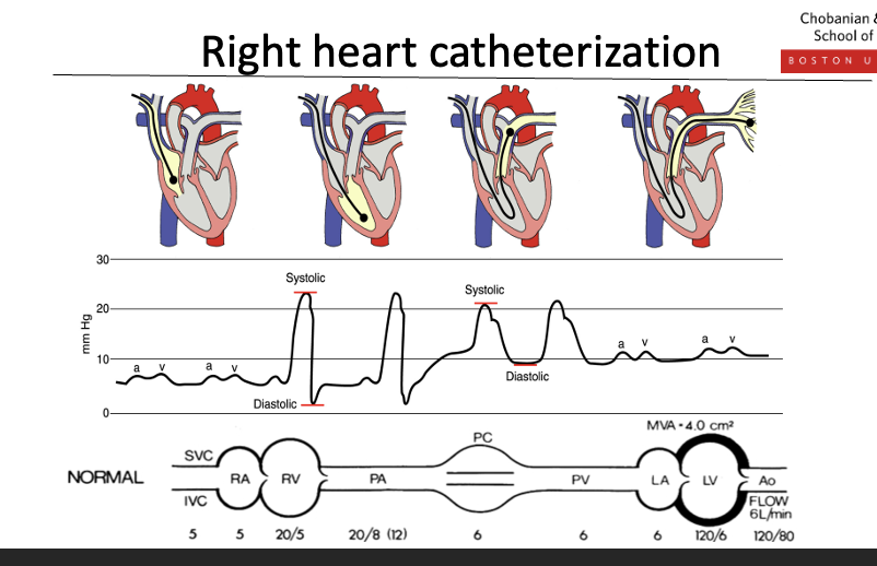 <p>What it measures </p><ul><li><p><strong>Right atrial pressure (RAP)</strong> → preload/systemic congestion</p></li><li><p><strong>Right ventricular pressure</strong></p></li><li><p><strong>Pulmonary artery pressure (PAP)</strong></p></li><li><p><strong>Pulmonary capillary wedge pressure (PCWP)</strong> → left atrial pressure / pulmonary congestion</p></li><li><p><strong>Cardiac output</strong> (thermodilution)</p></li><li><p><strong>Mixed venous oxygen saturation (SvO₂)</strong></p></li></ul><p> Clinical uses </p><ul><li><p>Diagnose and classify <strong>heart failure hemodynamic profiles</strong></p></li><li><p>Differentiate <strong>cardiogenic vs noncardiogenic shock</strong></p></li><li><p>Assess <strong>volume status and perfusion</strong></p></li><li><p>Evaluate <strong>pulmonary hypertension</strong></p></li><li><p>Guide therapy in <strong>severe or refractory HF</strong></p></li></ul><p> Relation to right heart catheterization </p><ul><li><p><strong>Right heart catheterization</strong> is the <strong>procedure</strong></p></li><li><p><strong>Swan–Ganz catheter</strong> is the <strong>tool used</strong> to perform it</p></li><li><p>The catheter is advanced through the <strong>right atrium → right ventricle → pulmonary artery</strong>, allowing measurement of pressures along the way</p></li></ul><p></p>