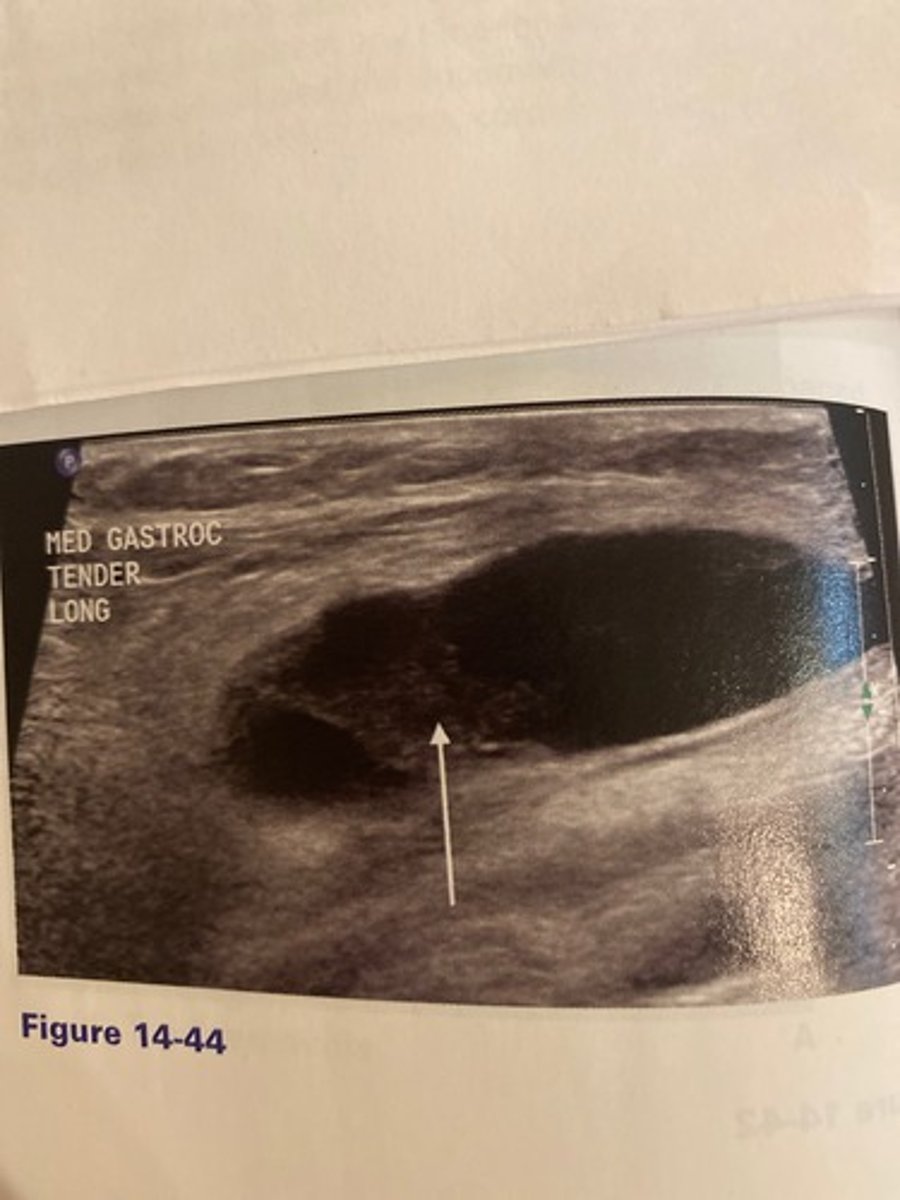 <p>The arrow in Figure 14-44 indicates hemorrhage within a mass noted behind the knee. Which of the following would be the least helpful task the the sonographer should perform in this case?</p><p>a. Apply color Doppler.</p><p>b. Perform the Thompson test.</p><p>c. Inquire if the patient has a history of rheumatoid arthritis.</p><p>d. Analyze the cyst for evidence of channel leading to the joint.</p>