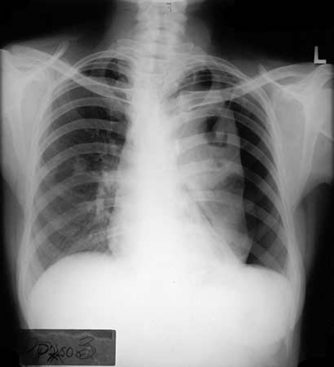 <p>-Hyper-translucent (black) area at site of pneumothorax<br>- Shift of mediastinum toward the unaffected side<br>- Lung collapse<br>- air in the pleural cavity caused by a puncture of the lung or chest wall</p>