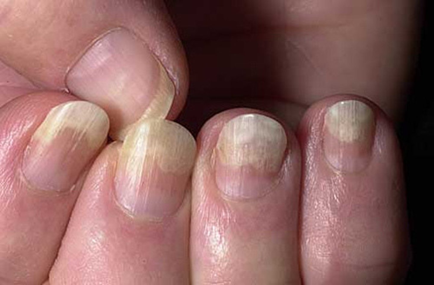<p>onycholysis</p>