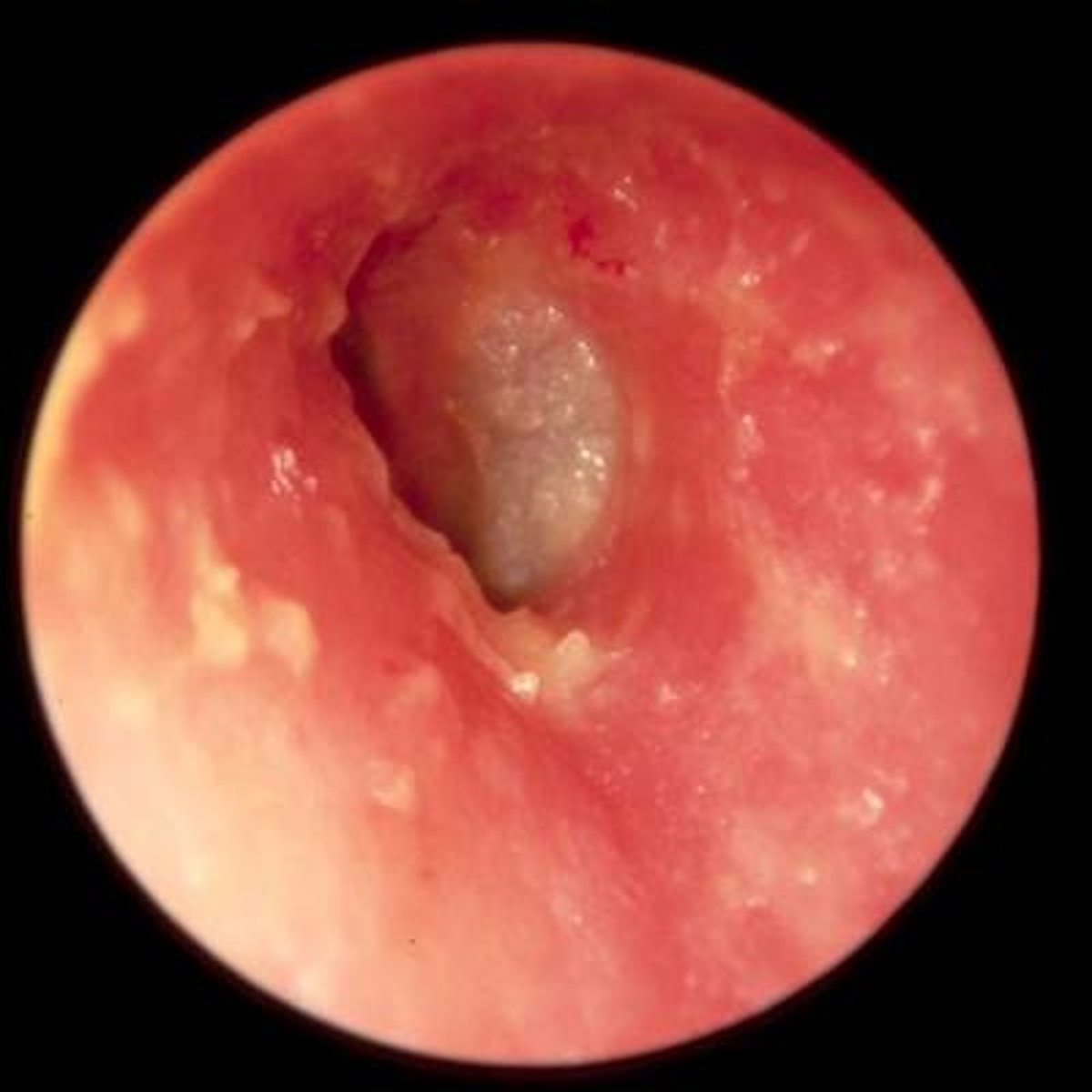 <p>- erythema and swelling of ear canal</p><p>- pus or discharge in ear</p><p>- lymphadenopathy in neck or around ear</p>