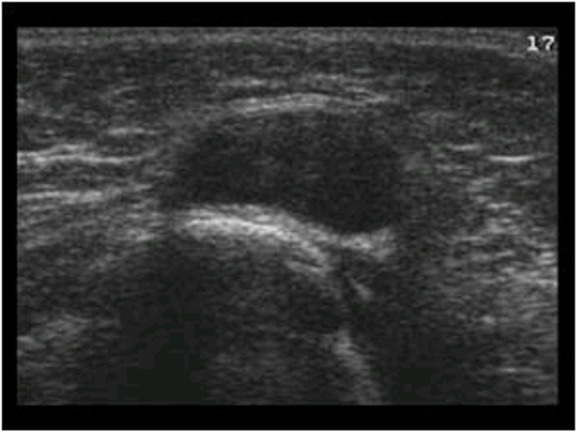 <p>most common</p><p>oval</p><p>midline of neck anterior to trachea, superior to isthmus</p>