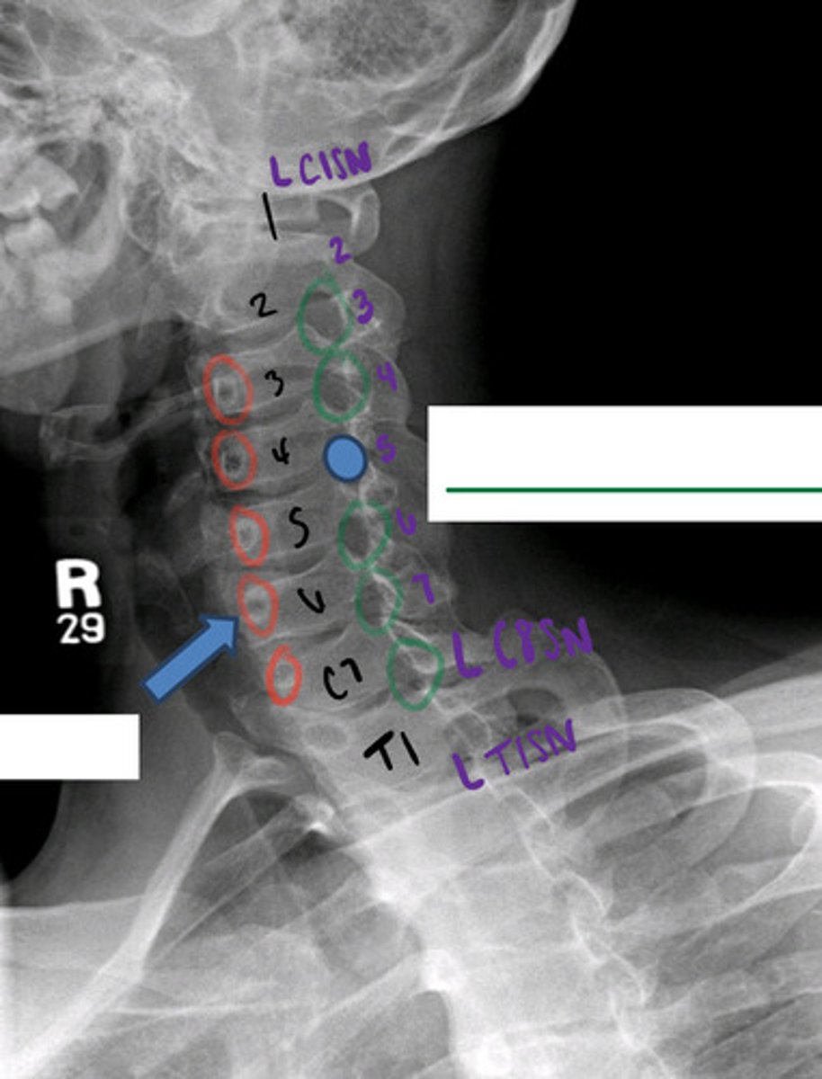 <p>what exits through the L neural foramina C4-5?</p>