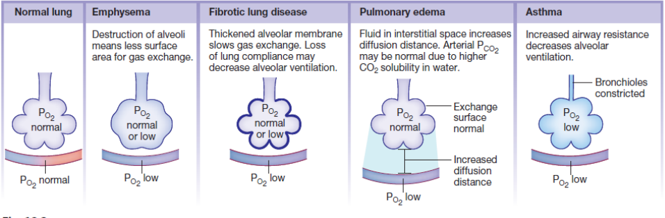 <ul><li><p>Emphysema</p></li><li><p>Fibrotic Lung Disease</p></li><li><p>Pulmonary oedema</p></li><li><p>Asthma</p></li></ul><p></p>