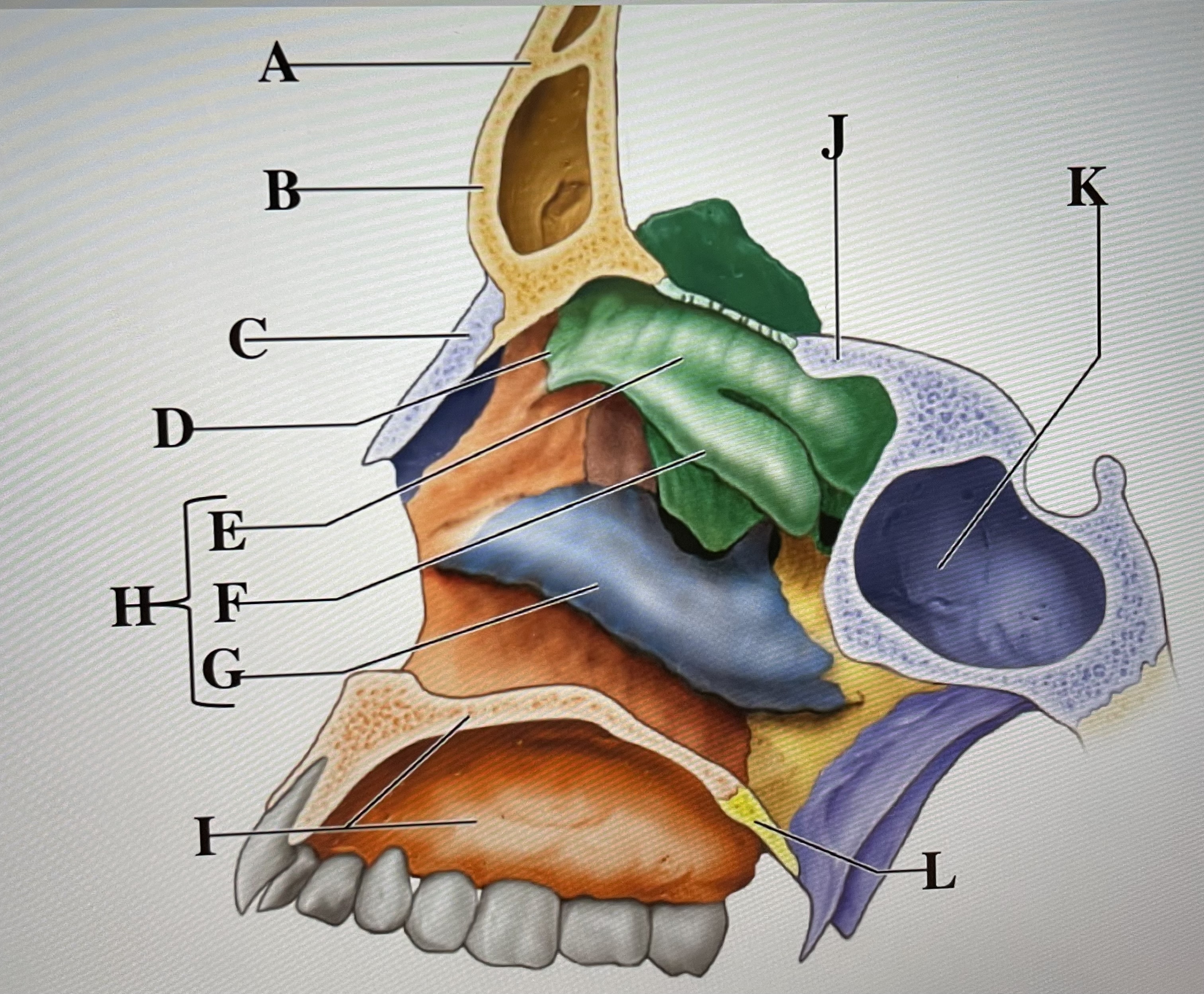 In the figure above,  *is the sphenoid sinus and letter* _ is the superior nasal conchae 