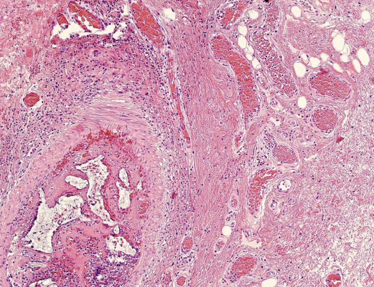 <p>proliferation of capillaries + endothelial cells containing abundant blood</p>