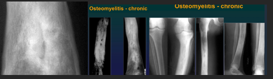 <ul><li><p>Chronic, evolution in bursts</p></li><li><p>Single bone, single place </p></li><li><p>Involves etaphyses an diaphyssis NOT epiphysis NOR joints</p></li></ul><p>Xray CharaK</p><ul><li><p>Bone sequestration</p></li><li><p>Osteosclerosis</p></li><li><p>Periostosis</p></li><li><p>Hyperostosis</p></li></ul><p></p>