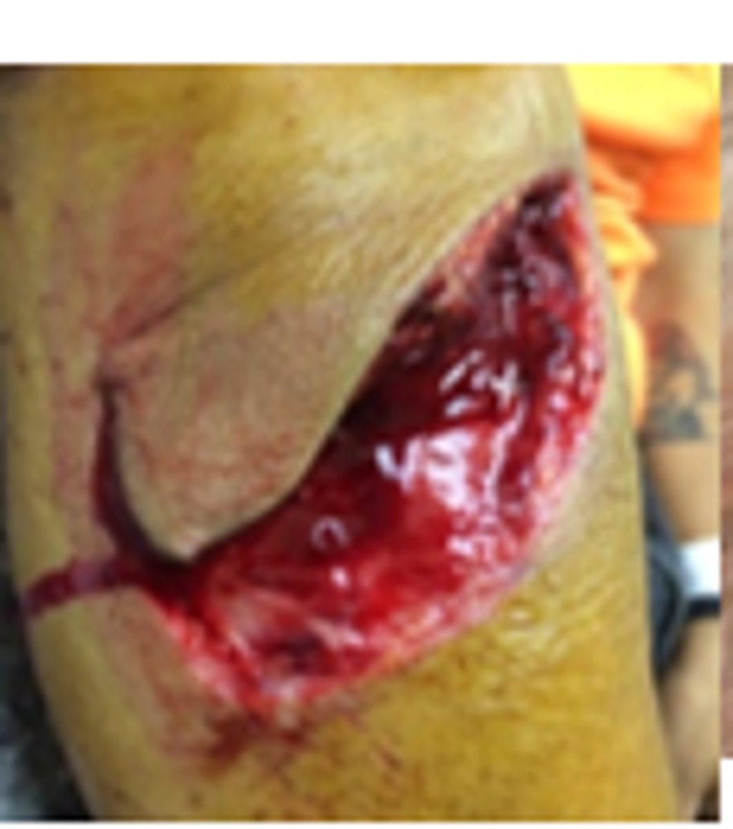 <p>Tension (blunt/semi blunt object striking skin at a glancing angle)</p>