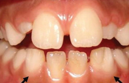 <p>dx (two teeth join together)</p>