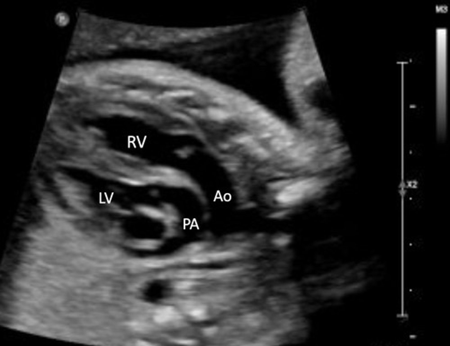 <p>Best seen in PSAX view</p><p>Pulmonary A originates from LV</p><p>AO originates from RV</p>