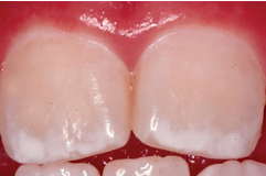 <p>ingestion of excessive fluoride when teeth are still developing which can lead to defective mineralization </p><ul><li><p>why children should not eat toothpaste :)</p></li></ul><p></p>