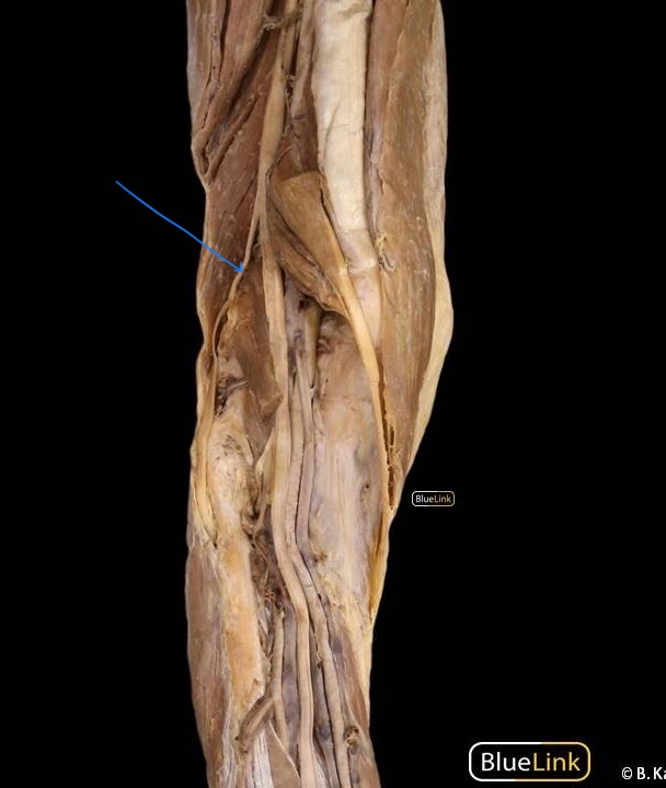<p>The lateral split of the sciatic nerve, divides into the superficial and deep fibular nerves.</p><p></p><p>innervates: short head of the biceps femoris</p>