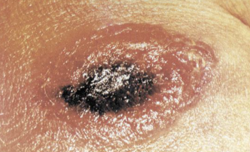 <p>Ulcers with necrotic centers</p><p>Bloated cadavers</p>