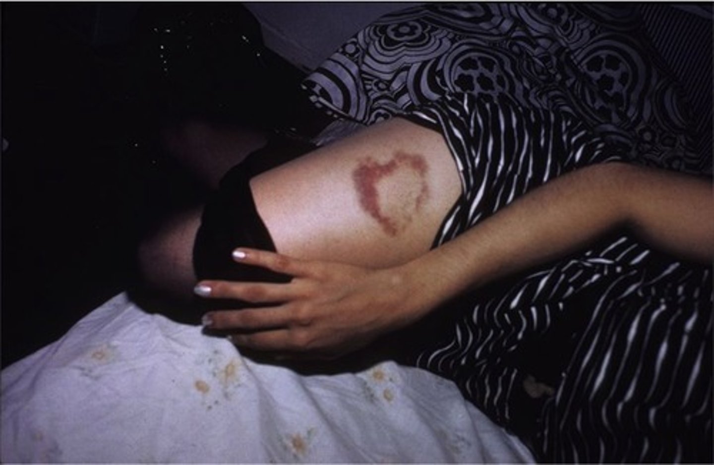<p>Heart-Shaped Bruise</p>