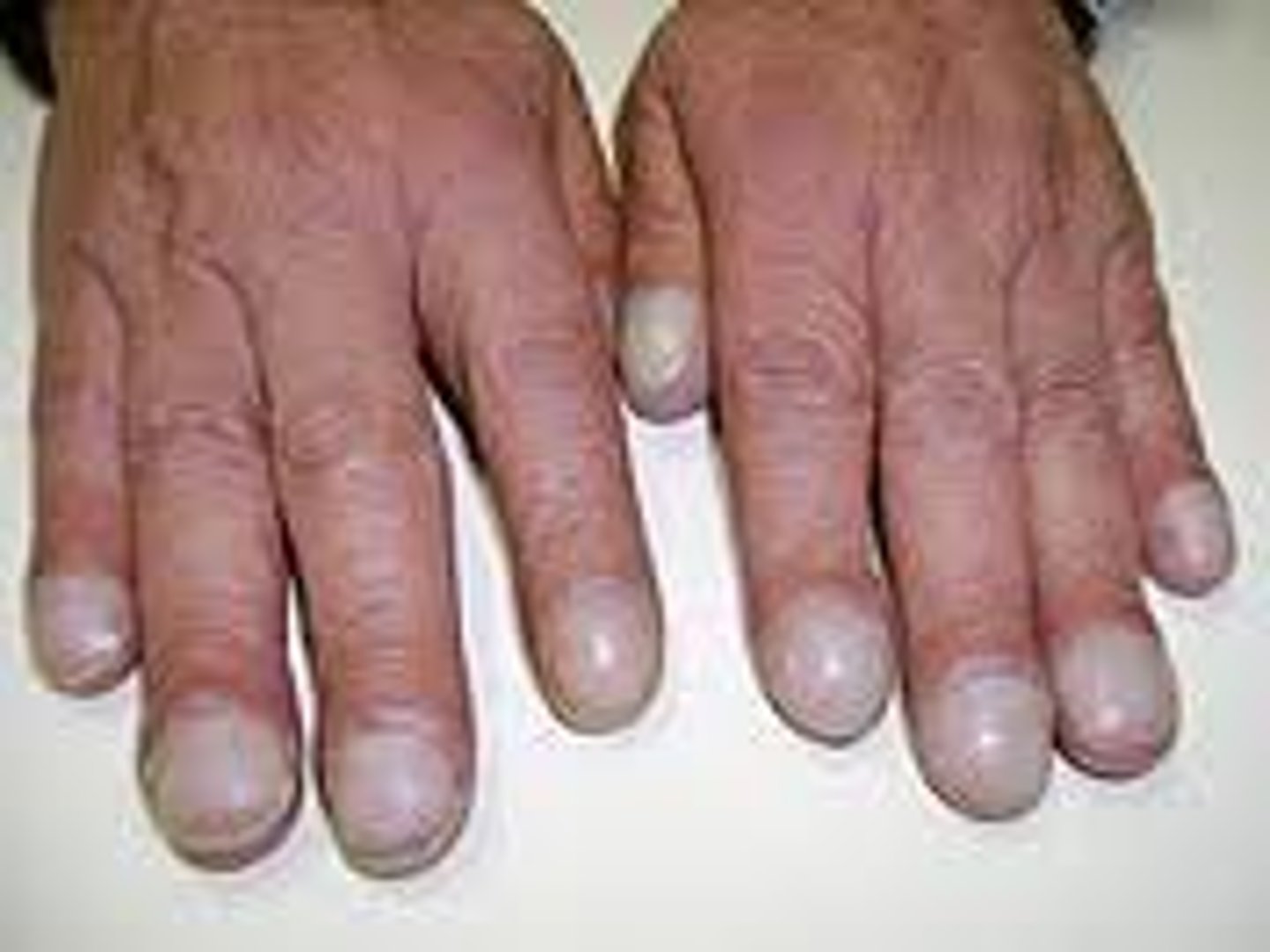 <p>Clubbing of the nails</p>