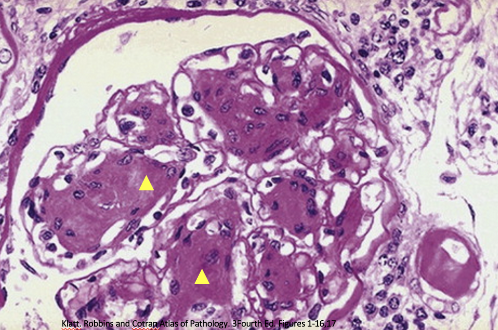 <p>From this image, what type of injury is indicated with this hyaline arteriolosclerosis? noted from the yellow triangles</p>