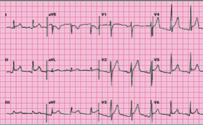 <p>Findings in pericarditis</p>