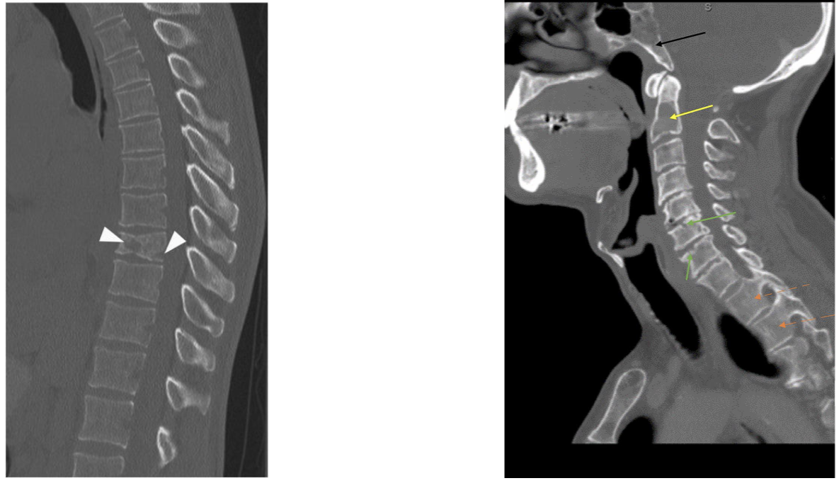 <p>Compression/infilration of nerves</p><p>Ulceration</p><p>Bone fracture</p><p>Pain Reduces appetite</p>