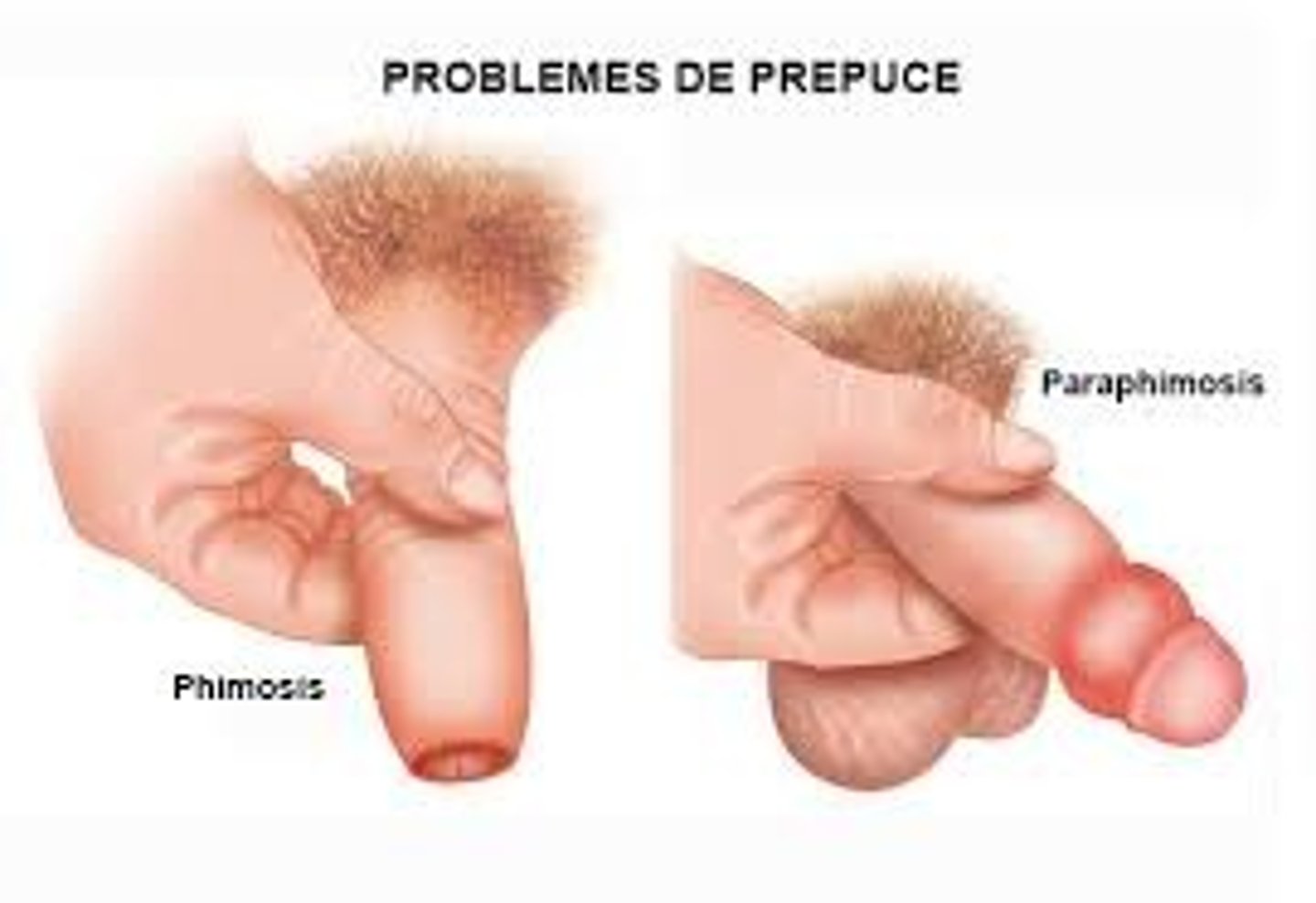 <p>paraphimosis</p>