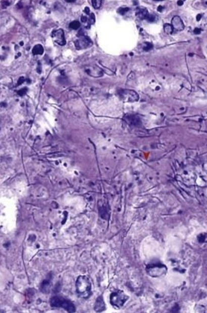 <p>8.6 Side B (PBD9: 367; BP9: 488)<br></p>
<p><br></p>
<p>Questions<br></p>
<p>A 63-year-old diabetic man has fever, weight loss, and cough with lingular infiltrates; biopsy shows gram-positive, weakly acid-fast organisms.<br></p>
<p><br></p>
<p>1. What infection is this, and what other tissue sites does it commonly infect?<br></p>
<p>2. Why did he develop this infection?<br></p>