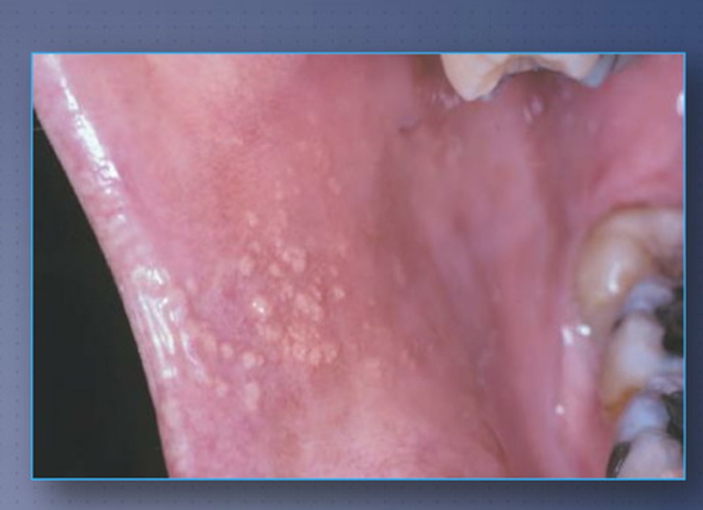 <p>Small bilateral yellow nodules of buccal mucosa and vermillion after puberty. Intraoral sebaceous (oil) glands.</p>