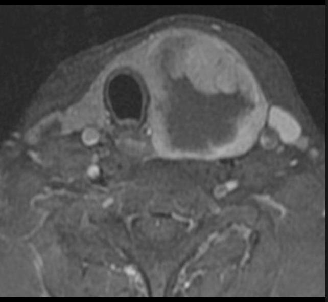 <p>What type of thyroid nodule is this - rare, aggressive, 2% of thyroid cancers and the patient presents with rapidly enlarging mass and compressive symptoms?</p>