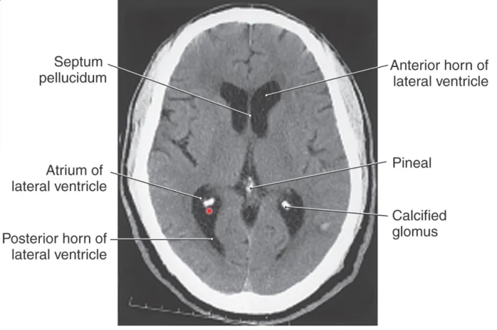 <p>calcified glomus</p>