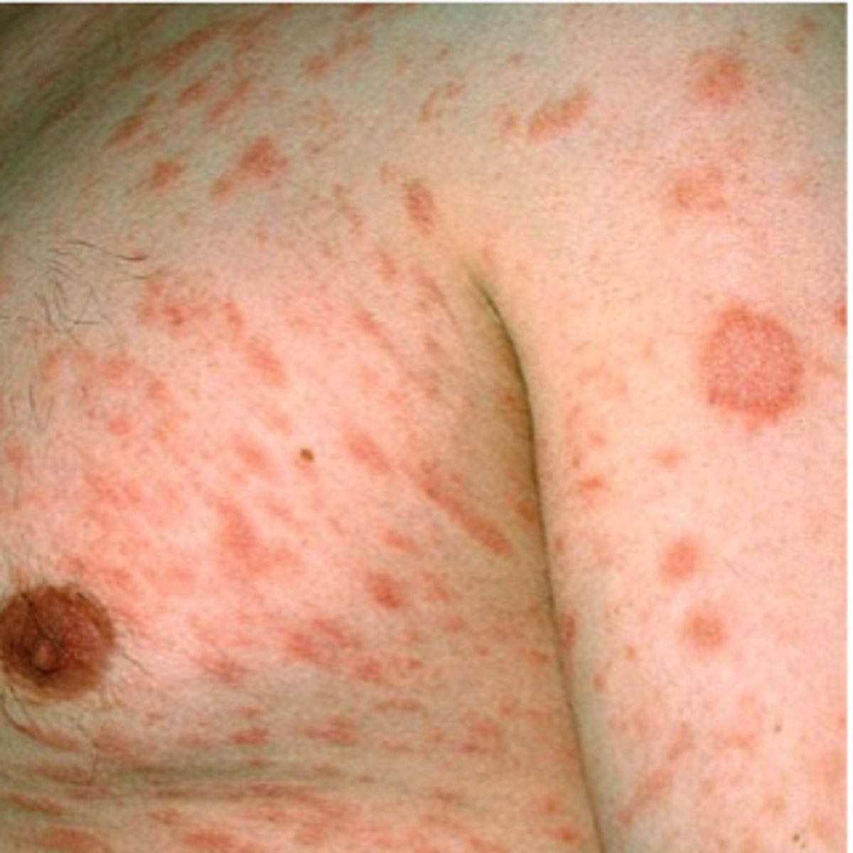 <p>Pityriasis Rosacea</p>