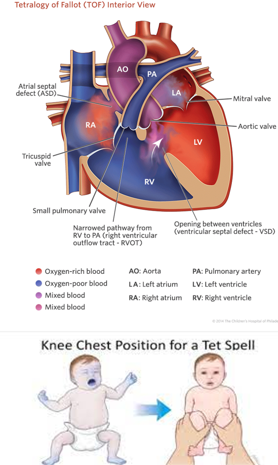 <p><strong><u>Decreased</u> Pulmonary Blood Flow</strong></p><ul><li><p><strong>4 Defects:</strong></p><ul><li><p><strong>Pulmonary Stenosis </strong>(narrowing)</p></li><li><p class=""><strong>Right Ventricular Hypertrophy</strong>—(obstructed blood flow to the lung causes increased right-sided pressure).</p></li><li><p class=""><strong>Overriding Aorta </strong>(goes over the septum)</p></li><li><p class=""><strong>Ventricular Septal Defect </strong>(VSD)</p></li></ul><p class=""><u>**PROVe = Pulm Stenosis, R Vent Hypertrophy, Overriding Aorta, VSD**</u></p></li><li><p class=""><strong>Treatment: Hypercyanotic Spells or “Tet Spells”</strong></p><ul><li><p class="">Use a calm, comforting approach.</p></li><li><p class="">Place in a <strong>knee-to-chest position</strong> (#1)—it increases peripheral vascular resistance, which reduces right-to-left shunt at the VSD = increased pulmonary blood flow.</p><ul><li><p class="">Educate parents!</p></li></ul></li><li><p class=""><strong>In the Hospital</strong>:</p><ul><li><p class="">Provide supplemental oxygen.</p></li><li><p class="">Administer Morphine (IV, IM, or SQ)—helps the child calm, reduces tachypnea, and decreases vascular resistance.</p></li><li><p class="">Supply IV Fluids</p></li></ul></li></ul></li></ul><p></p>