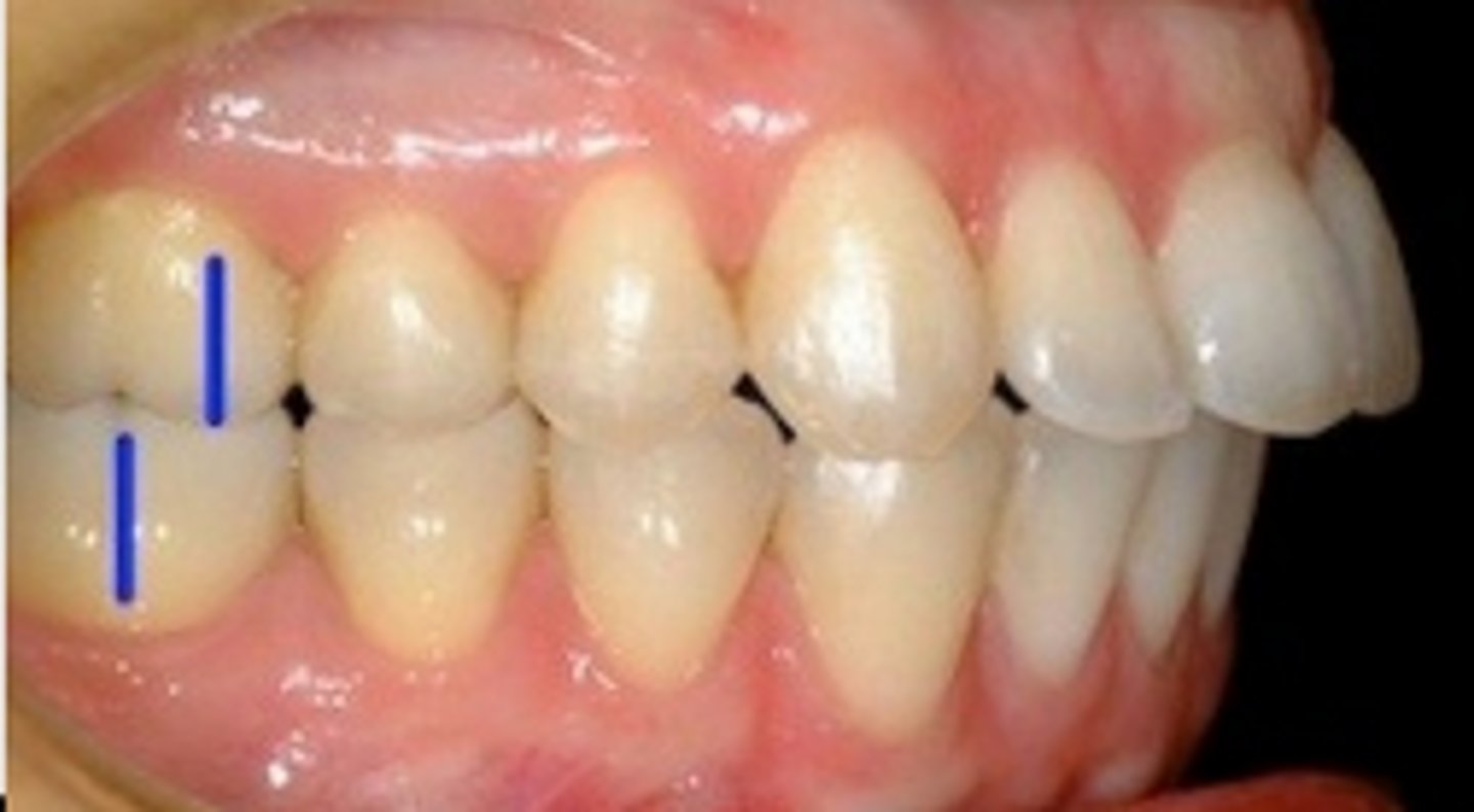 <p>ID the class of occlusion:</p>