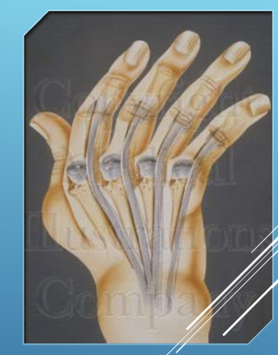 <p>Deformities are usually manifested by palmar subluxation and increasing ulnar deviation.&nbsp;</p><ul><li><p>the extensor tendons often sublux ulnarly into the valleys between the MCP joints </p></li><li><p>the flexor tendons may also slip ulnarly when the collateral ligaments are stretched by the inflamed and edematous joint. </p></li></ul><p></p>