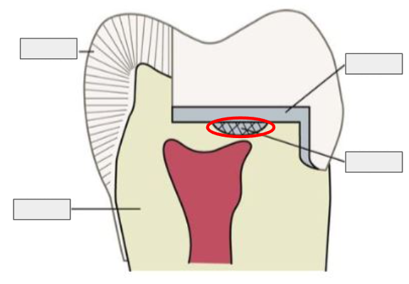 <p>A thin protective layer placed on the tooth to shield the pulp from irritation.</p><p></p><p>Thin layer of material to protect the pulp</p>