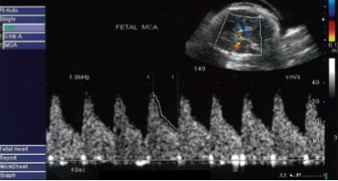 <p>Doppler of the MCA was done and this was seen. </p><ol><li><p>Is this waveform normal or abnormal?</p></li><li><p>If abnormal, what pathology can it be indicative of?</p></li></ol><p></p>