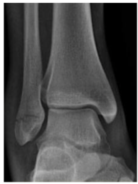 <p>55 y/o female presents to the ED for ankle pain after rolling her ankle going down the stairs. On physical exam you note swelling, ecchymosis, and pain to the lateral ankle over the distal fibula. See xray. What is your treatment plan?</p>