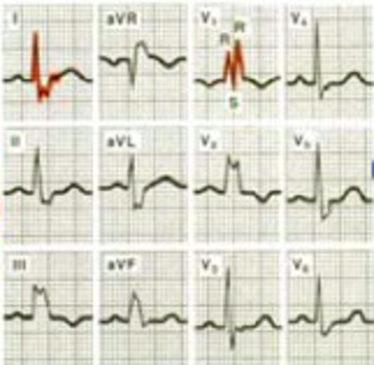 <p>- wide QRS &gt;3 boxes (0.12)</p><p>- V1/V2 "bunny ears" (2-R waves)</p><p>(V1/2/3 all up)</p><p>- common, doesn't have much path assoc</p>