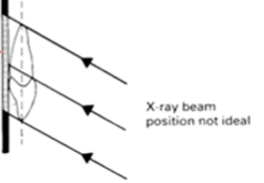 <p>Xray position not ideal </p>