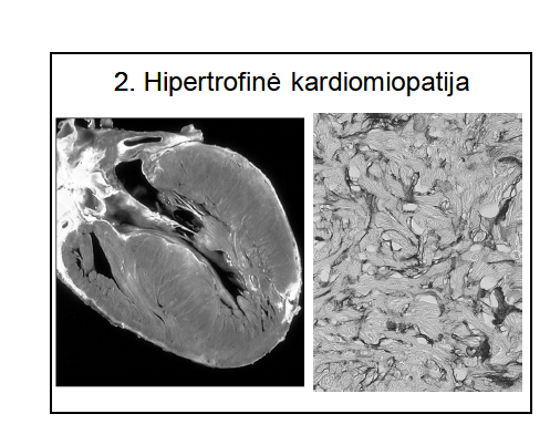 <p>Makroskopiškai</p><p>Ryški kairiojo skilvelio (iki 400-500 g) ir tarpskilvelinės pertvaros simetrinė ar asimetrinė (tik pertvaros) hipertrofija - ženklus sustorėjimas</p><p>Ryški pertvaros asimetriją jei asimetrinė</p>
