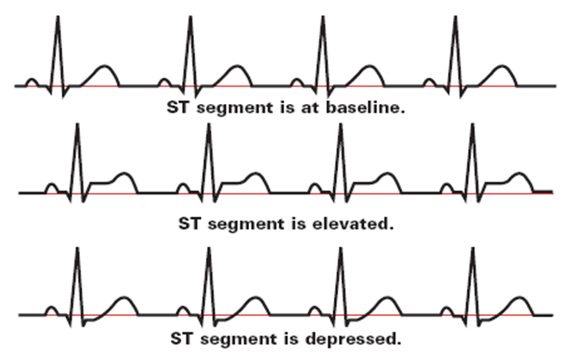 <ul><li><p><span style="font-family: Calibri">ST segment is at baseline - NORMAL!</span></p></li><li><p><span style="font-family: Calibri">ST segment is elevated - STEMI</span></p></li><li><p><span style="font-family: Calibri">ST segment is depressed</span></p><p></p></li></ul>