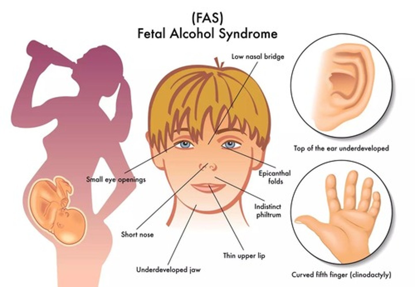 <p>Causes mental & growth retardation, birth defects of face and limbs, behavioral problems including ADHD, cognitive delays</p>