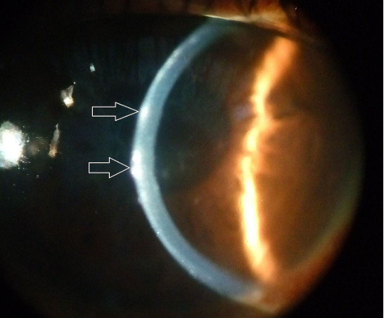 <p>what layer of the cornea are the arrows pointing to&nbsp;</p>
