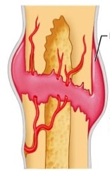 Occurs in the reactive phase of fracture repair, and is where a mass of blood pools around the site of the fracture.
