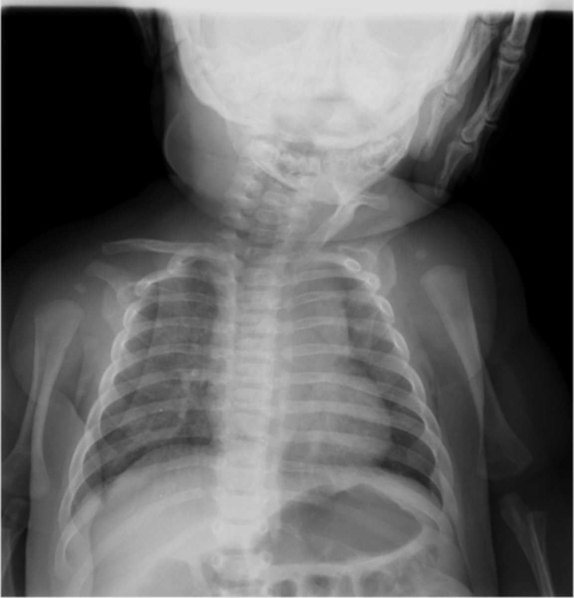 <p>- Congenital elevation of the shoulder</p><p>- Improper migration of the scapula</p><p>- May occur without Klippel-Feil Syndrome</p>