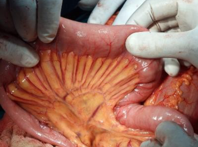<p><span><span>the serous membrane lining the cavity of the abdomen and covering the abdominal organs.</span></span></p>